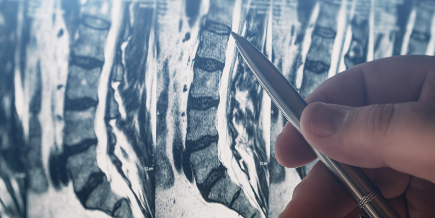 Doctor examines MRI of lumbar spine